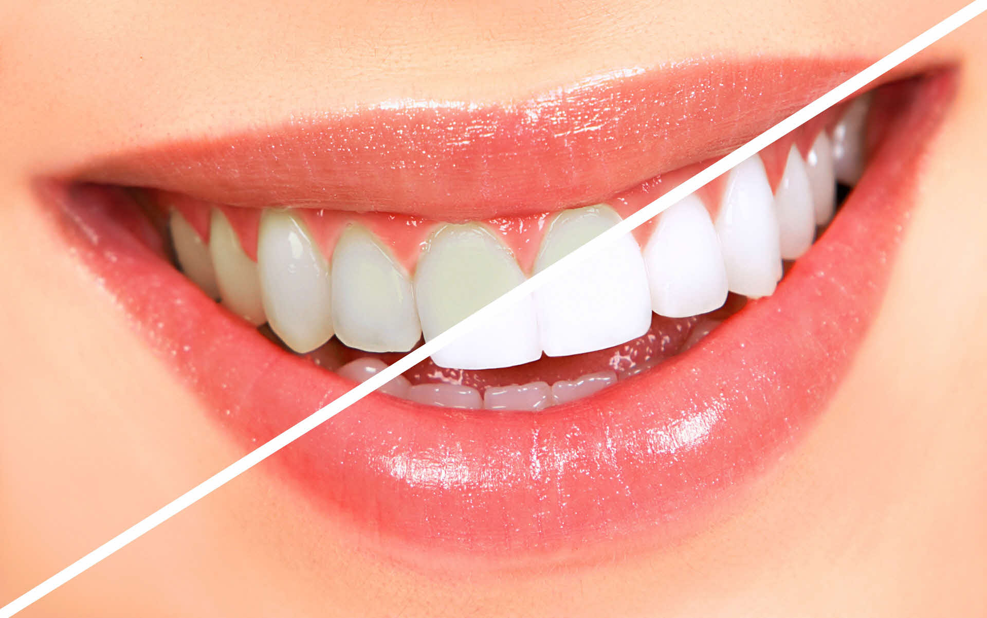 Clareamento dental