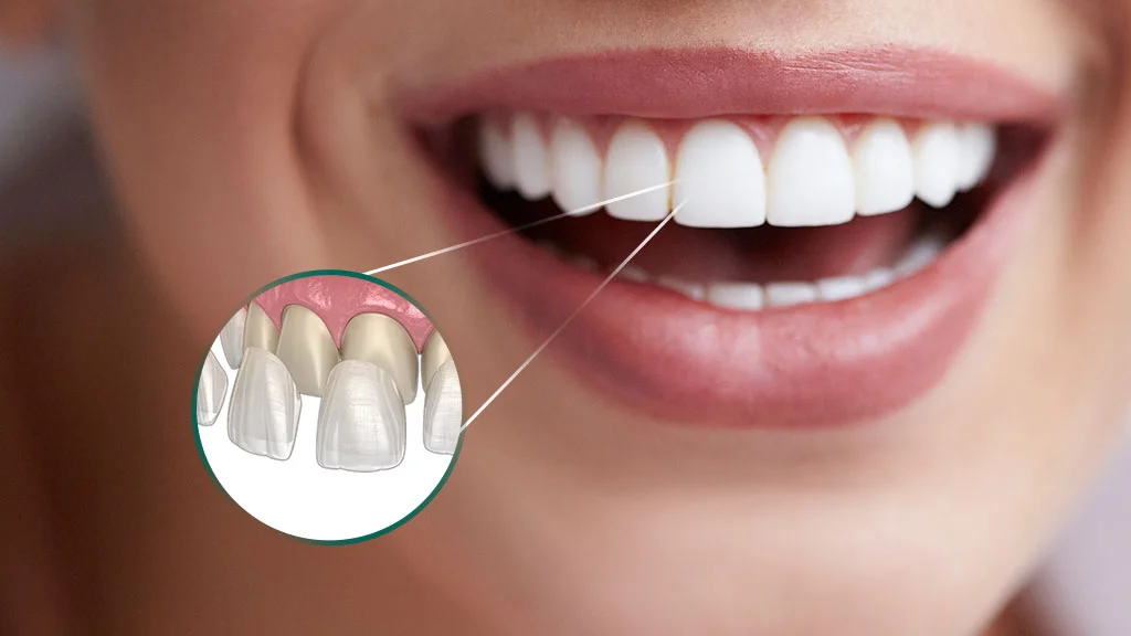 Lentes de contato dental