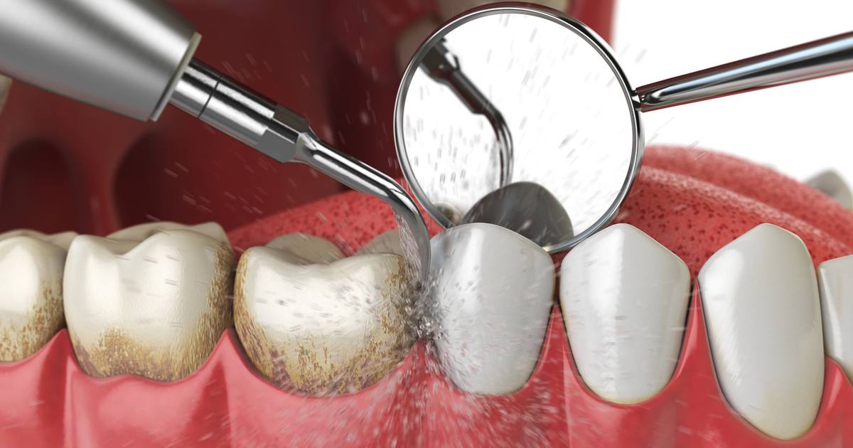 Limpeza dental